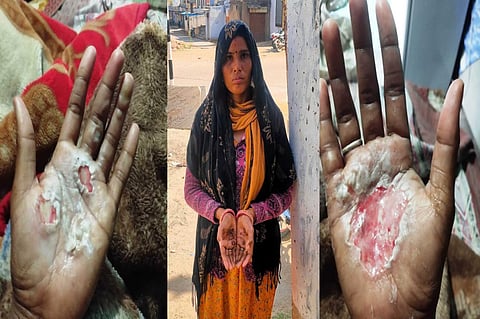 अंधविश्वास: महिला पर भूत का साया बताकर तांत्रिक ने हाथों में रखे अंगारे!