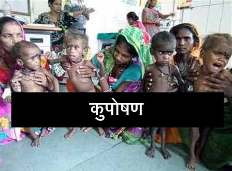 मध्य प्रदेश: 78 हजार से ज्यादा कुपोषित बच्चे, आदिवासी बहुल क्षेत्रों में क्यों बढ़ रहा है कुपोषण?