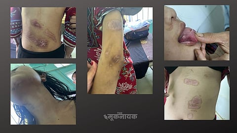 पीड़िता के शरीर पर चोटों के निशान