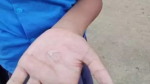 हाथ में पड़े फफोले को दिखाता बच्चा