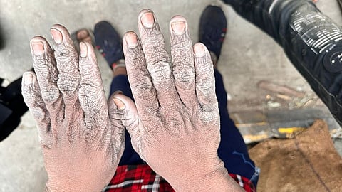 शराब की फैक्ट्री में काम करने से एल्कोहल से जला बच्चे का हाथ.