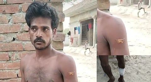 कुल्हाड़ी के हमले से घायल मुकेश को हाथ पैर में आई चोटें.