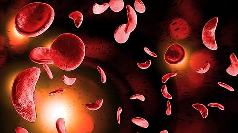 MP: इंदौर में 400 से अधिक आदिवासी होस्टलर्स की स्क्रीनिंग में 65 सिकल सेल एनीमिया संदिग्ध!