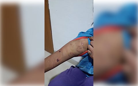 नाबालिग बच्ची के शरीर पर घाव के निशान