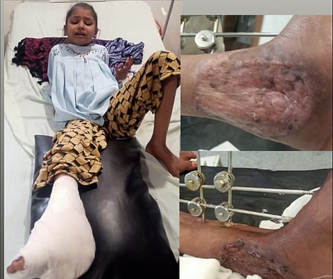 MP: उज्जैन में नौ वर्षीय बच्ची के पैर खराब होने का मामला, बिना रजिस्ट्रेशन के संचालित था क्लीनिक, न्याय के लिए भटक रहा पीड़ित परिवार!