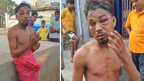 Marks on the body of a Dalit youth due to beating.