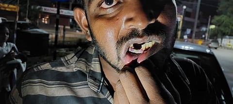 FIR against Suspended TN ASP for Third-Degree Torture and Extracting Teeth of Accused Persons