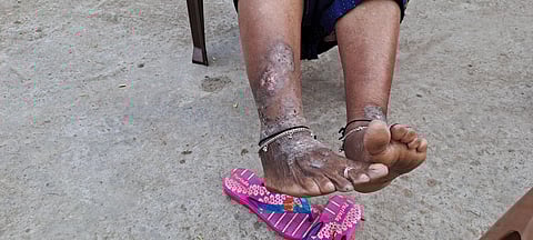 The impact of contaminated water persists in the region surrounding Union Carbide, a result of massive dumping of factory waste. Post the gas tragedy, residents suffer from diseases such as cancer, kidney ailments, skin infection and disabilities.