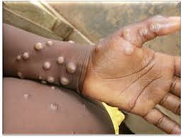 No Monkeypox Cases in India So Far, Health Minister Reviews Preparedness