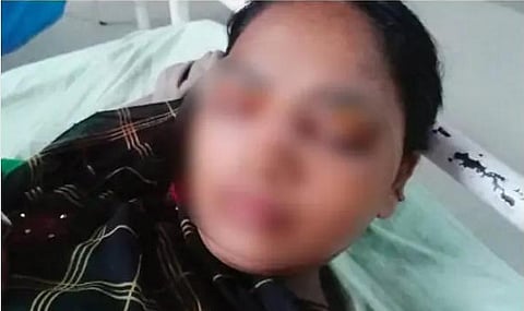 Three Days After Her Eyes, Eye Brows Were Burnt For Resisting Harassment, Culprits Still Out Of Police Reach