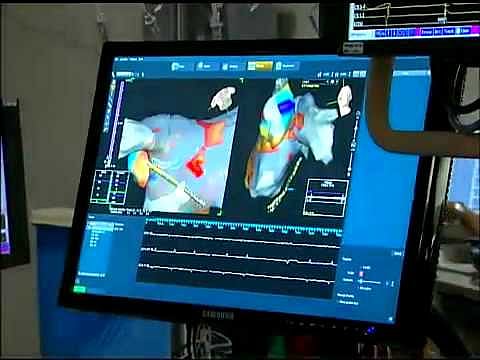 Fortis Memorial Research Institute Launches CATH LAB With India’s First ‘3D Mapping Carto 7 Machine’
