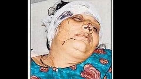 Woman Assaulted In Kanpur, Left With 163 Stitches