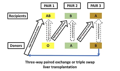 India’s First Three-way Swap Liver Transplant Chain At Medanta Saves Three Lives