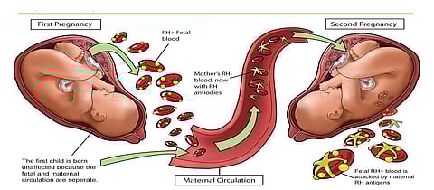 Same Blood Group Doesn’t Affect Pregnancy – RH Factor Is The Real Concern, Say Experts