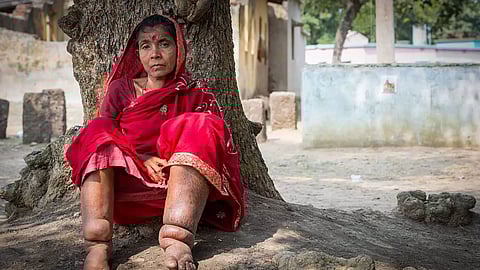 In Odisha, Tilottama Mahapatra, a patient suffering from acute lymphoedema, seeks relief under a tree. It can cause intense pain, fever, and swelling.