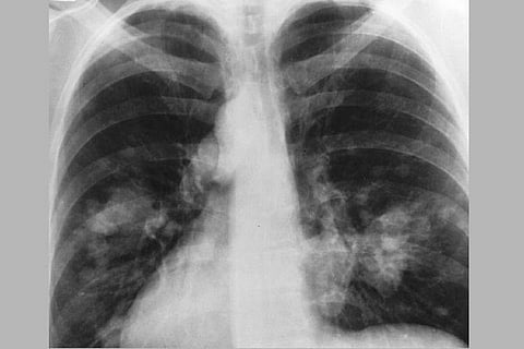 Lung x-ray