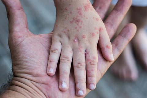 Monkeypox: The new viral disease outbreak on the horizon