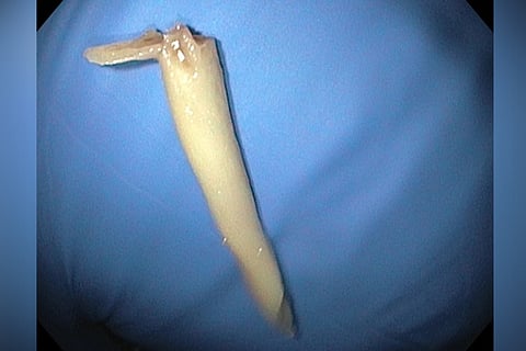 Two days after chicken bone gets stuck in boy’s throat, Hyd docs remove it
