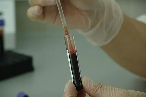Three die in one family in Kozhikode due to viral fever, district on high alert
