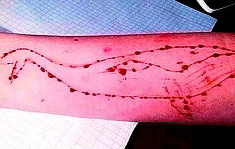 Blue Whale fear: 20 kids in Belagavi Kendriya Vidyalaya found with cuts on arm, say they were 'boasting'