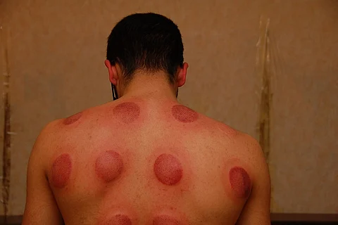 Cupping at the Olympics – what is it and why do athletes use it?