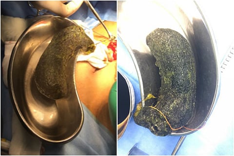 Three-fourths of stomach blocked by hair, Chennai teen finds relief after surgery