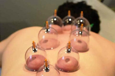 Furore after a Facebook post by Kerala doctors criticising 'Hijama' is taken down
