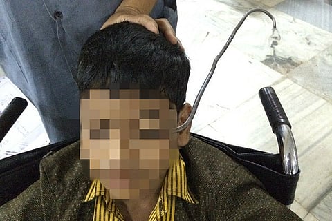 12-year-old Hyd boy operated on for iron hook pierced in eye and skull
