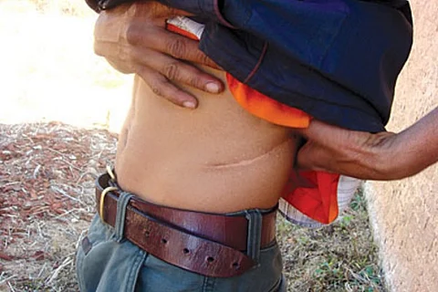 India’s latest kidney racket shows the govt is far behind in stopping the menace