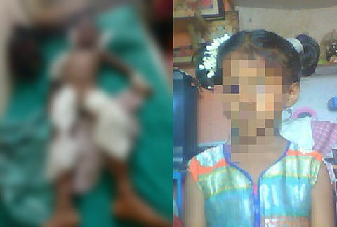 Stray dogs attack, rip flesh off six-year-old Bengaluru girl