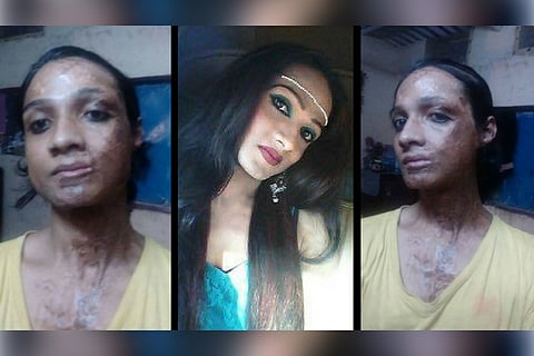 Gangraped and burned with acid, this transgender woman from Hyderabad needs your help