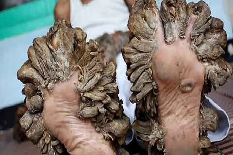 Relief for Bangladeshi ‘tree man’ as doctors remove ‘branches’ from hands and feet