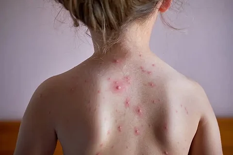 chicken pox