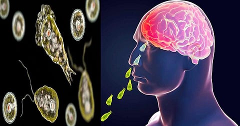 Amebic encephalitis