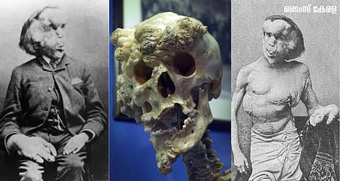 Joseph Carey Merrick
