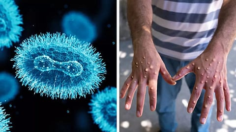 ലോകത്തിന് ഭീഷണിയായി എംപോക്സ്: സിറം ഇന്സ്റ്റിറ്റ്യൂട്ടില് വാക്സിന് ഒരുങ്ങുന്നു | Mpox vaccine