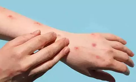 മലപ്പുറത്തേത് എം പോക്സിന്റെ അതിവേഗം വ്യാപിക്കുന്ന ക്ലേഡ് വൺ വകഭേദം; ഇന്ത്യയിൽ സ്ഥിരീകരിക്കുന്നത് ആദ്യം