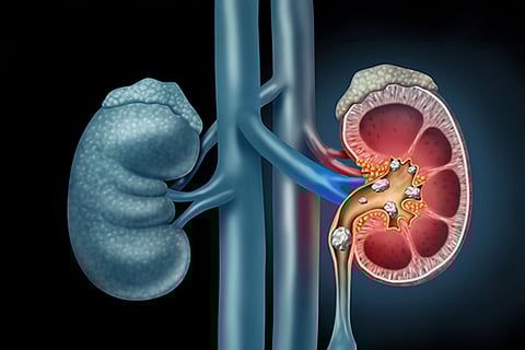 വൃക്കയിലെ കല്ലുകളെ നിസ്സാരമായി കാണണ്ട; തിരിച്ചറിയാം ഈ ലക്ഷണങ്ങളെ | Kidney Stone Symptoms