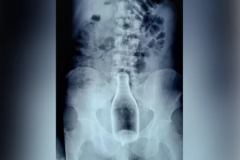 Drunk man inserts glass bottle into body through anus, surgically removed in TN