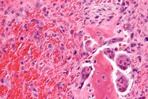 Destroying tumours with gold nanoparticles: The new hope in cancer treatment