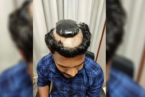 Smart, but not quite: Kerala man shaves hair to smuggle gold under wig, nabbed