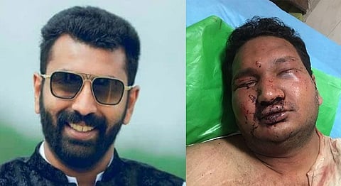 Nalapad's victim has trouble breathing, kin may move him to another city for treatment