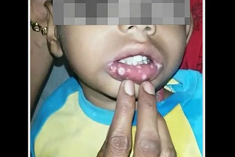 Hyd boy's parents allege polio vaccine caused severe ulcers, docs sceptical