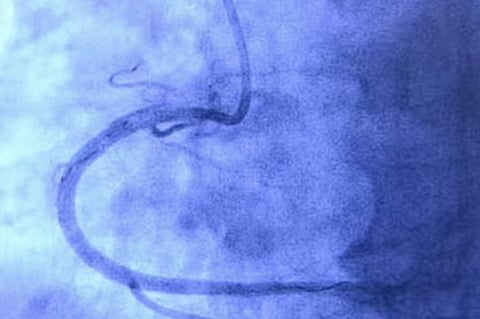 Complex Angioplasty: Why you will no longer need a risky open heart surgery