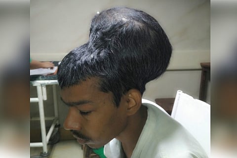 World's largest brain tumour weighing 1.8 kg removed successfully in Mumbai hospital