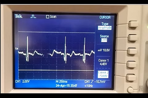 If you have irregular heartbeat, you have reason to be worried