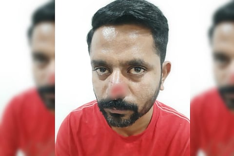 Hyderabad man bites off part of friend’s nose over financial dispute, booked