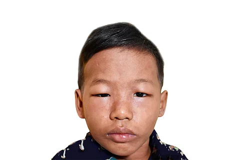Don’t ignore swollen eyelids, it could be nephrotic syndrome