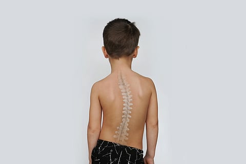 Spinal cord anomalies in children, a common but unrecognized problem