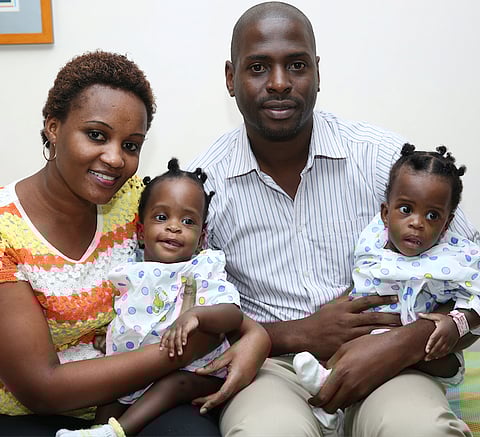 Chennai hospital successfully separate rare conjoined twins from Tanzania